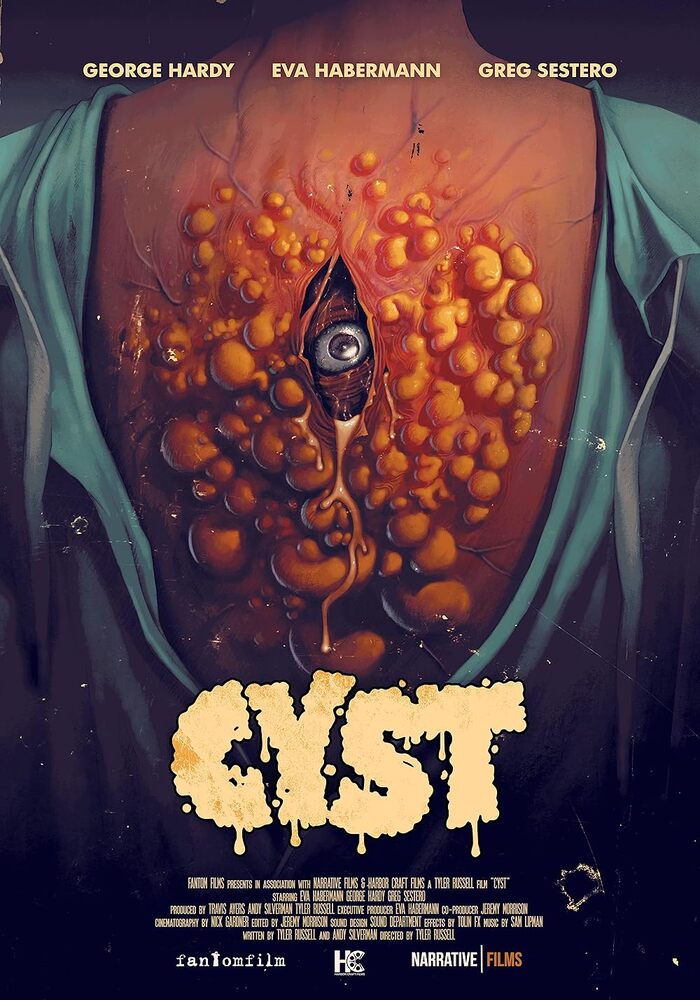 cyst